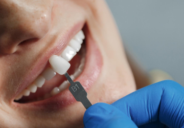 les dents sous les facettes