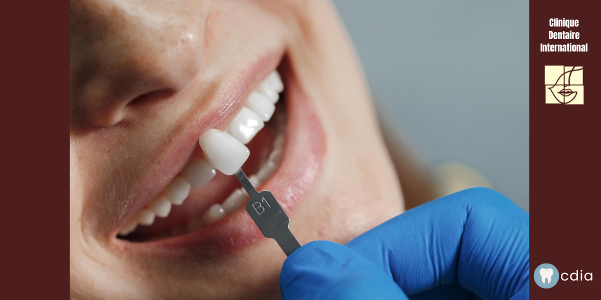 les dents sous les facettes