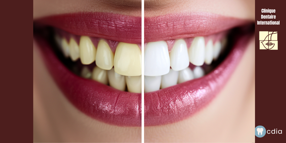le blanchiment des dents