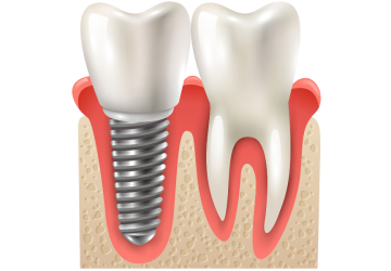 Combien coûte un implant dentaire
