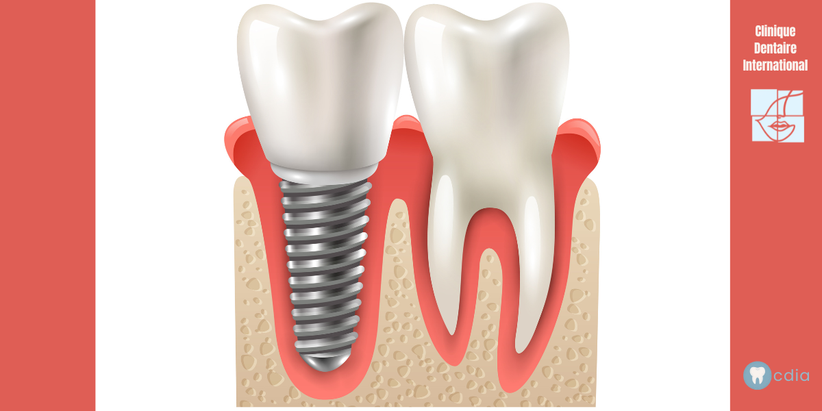 Combien coûte un implant dentaire