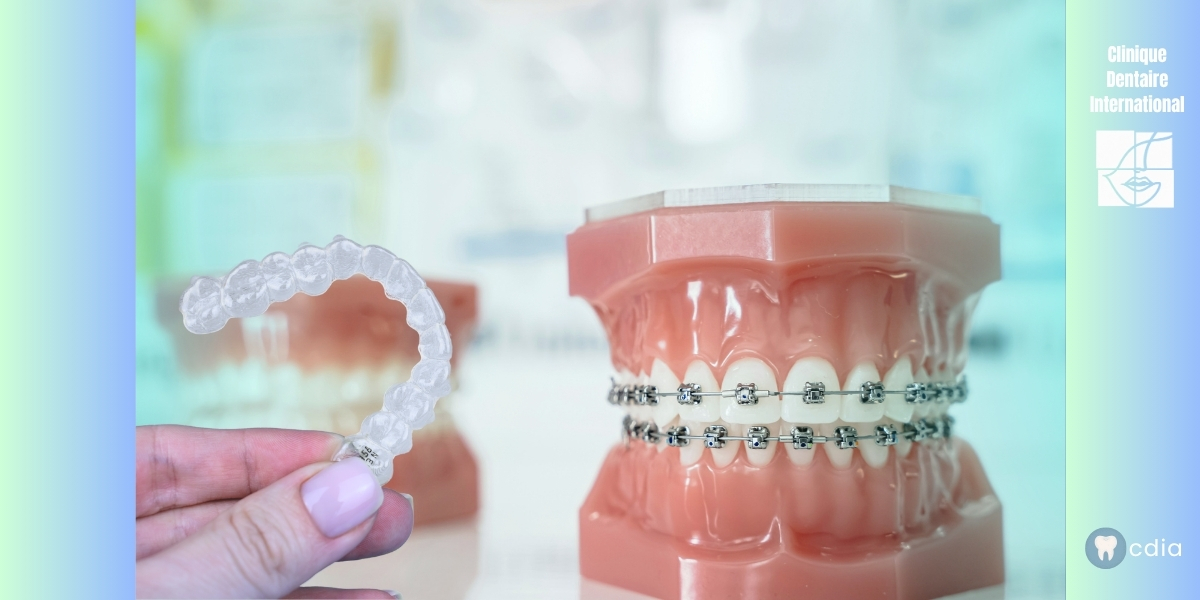 Comparaison aligneurs transparents vs appareils dentaires