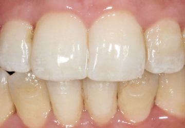 Blanchiment dentaire