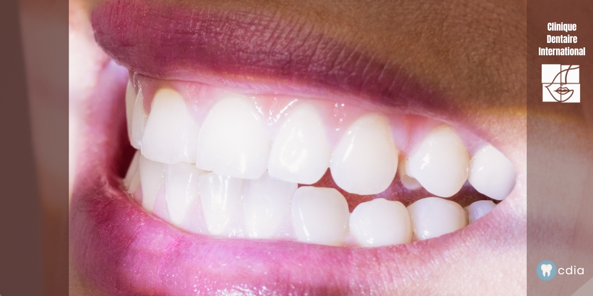 Blanchiment dentaire