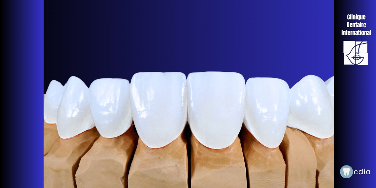 Pourquoi Vos Facettes Dentaires Ont l’Air Fausses (et Comment l’Éviter)