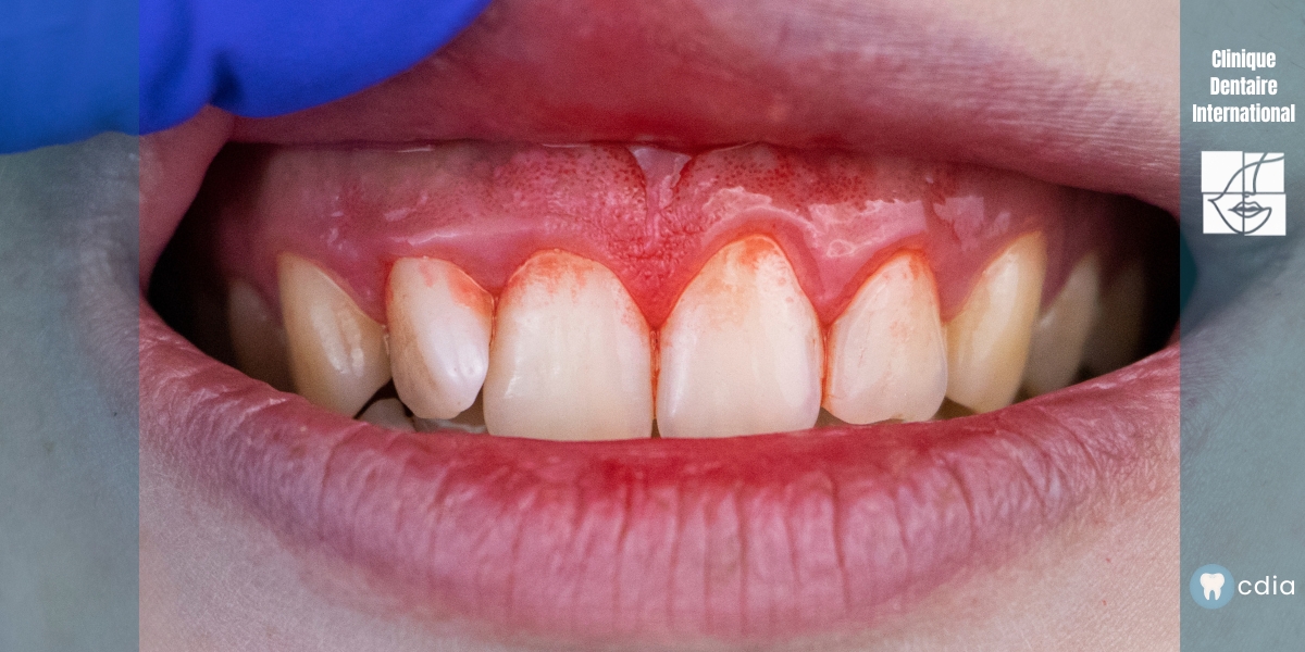 Gencives qui saignent