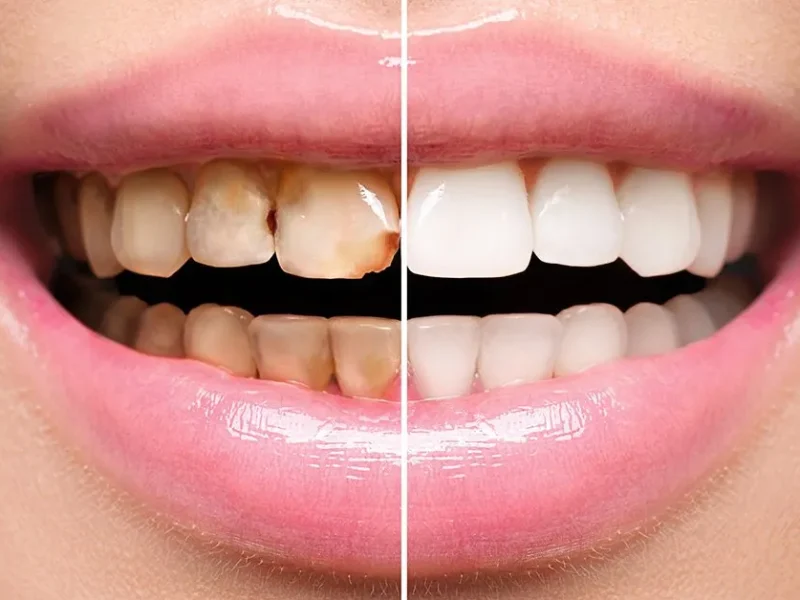 teeth-before-and-after-1920w